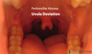 Peritonsillar Abscess Uvula Deviation