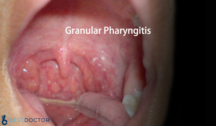 papilloma és pharyngitis