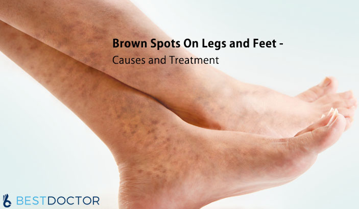 Brown Spots On Ankles Feet