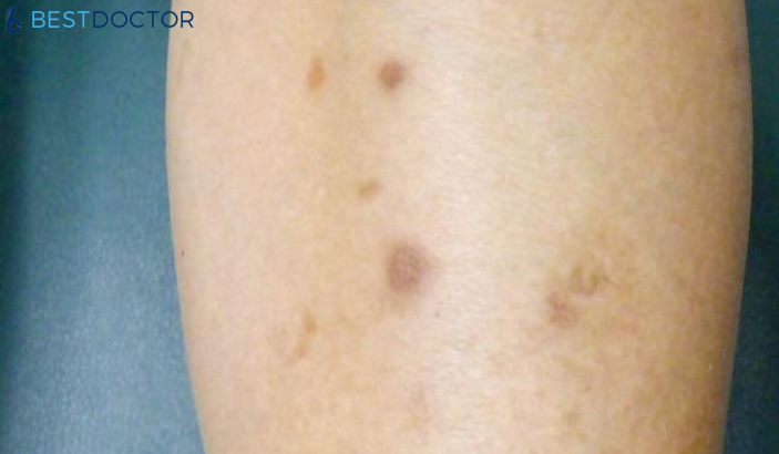 Brown Spots On Legs And Feet Causes Treatment Pictures By Dr Ahmed