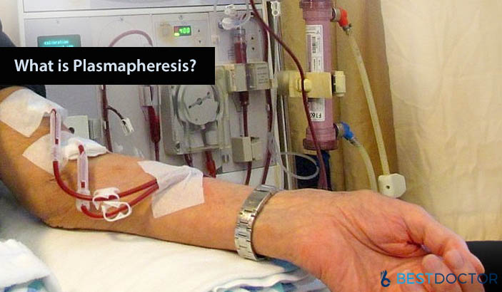 what-is-plasmapheresis-procedure-side-effects-cost-and-more-by-dr-ahmed