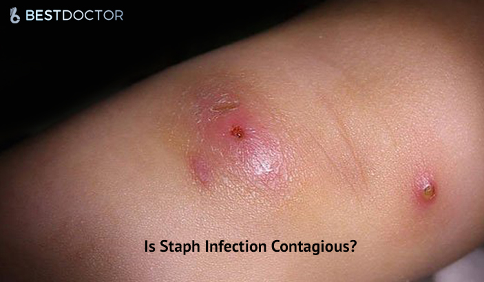 Is Staph Infection Contagious Your Questions Answered