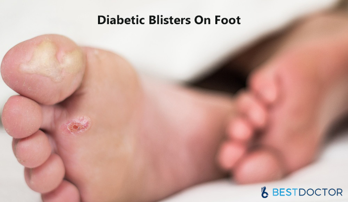 diabetic-foot-blister-treatment-prevention-and-complications