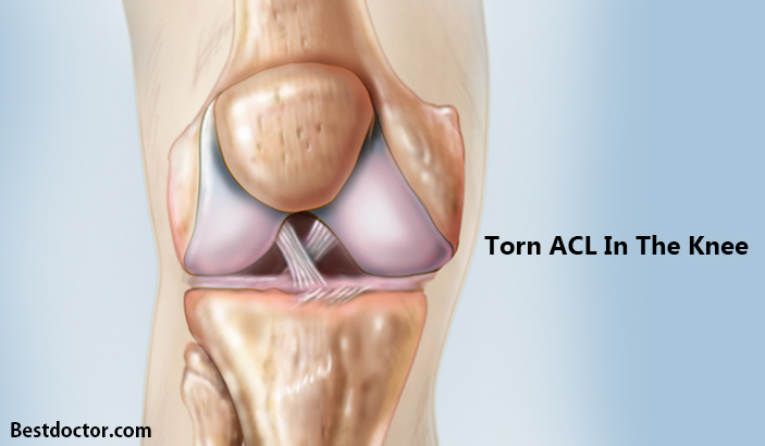 sprained acl