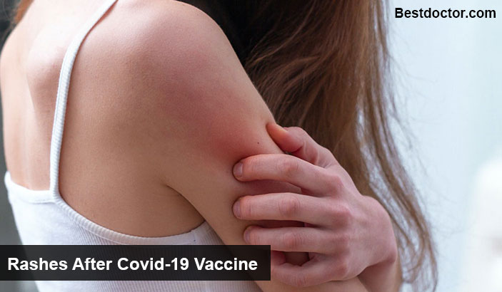 Rashes After Covid-19 Vaccine